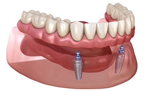 over denture implant attachments